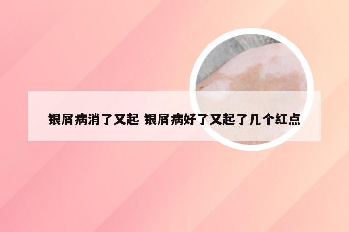 银屑病消了又起 银屑病好了又起了几个红点