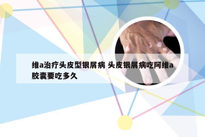 维a治疗头皮型银屑病 头皮银屑病吃阿维a胶囊要吃多久