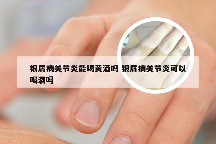银屑病关节炎能喝黄酒吗 银屑病关节炎可以喝酒吗