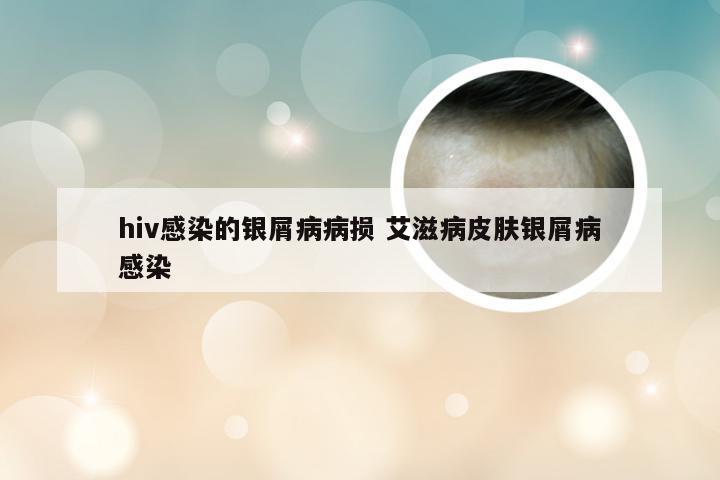 hiv感染的银屑病病损 艾滋病皮肤银屑病感染