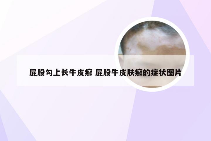屁股勾上长牛皮癣 屁股牛皮肤癣的症状图片