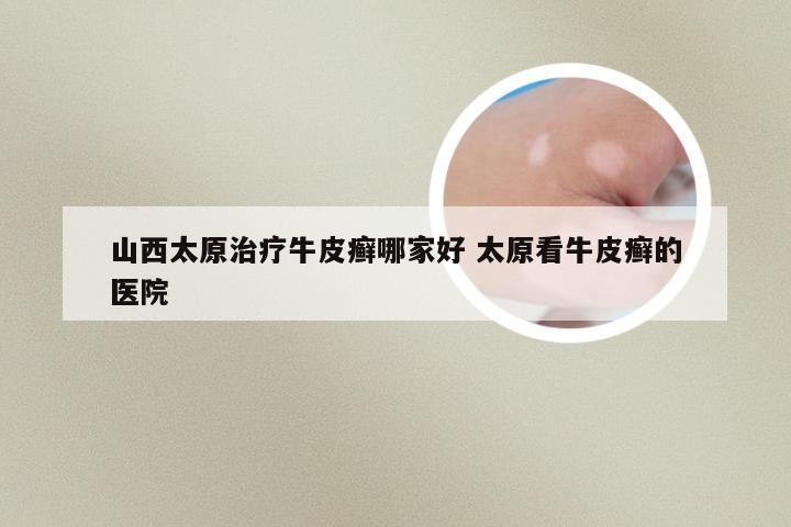 山西太原治疗牛皮癣哪家好 太原看牛皮癣的医院