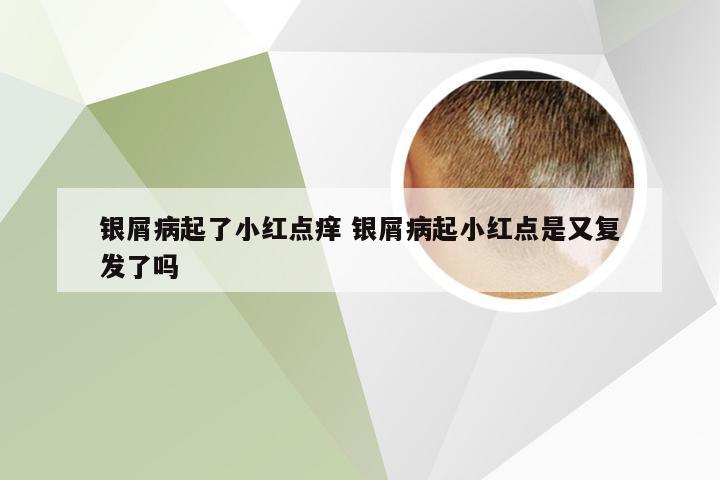银屑病起了小红点痒 银屑病起小红点是又复发了吗
