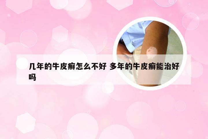 几年的牛皮癣怎么不好 多年的牛皮癣能治好吗