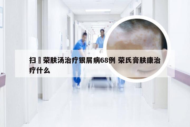 扫疕荣肤汤治疗银屑病68例 荣氏膏肤康治疗什么