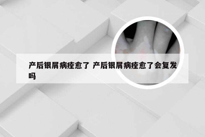 产后银屑病痊愈了 产后银屑病痊愈了会复发吗