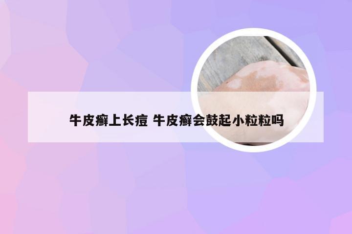 牛皮癣上长痘 牛皮癣会鼓起小粒粒吗