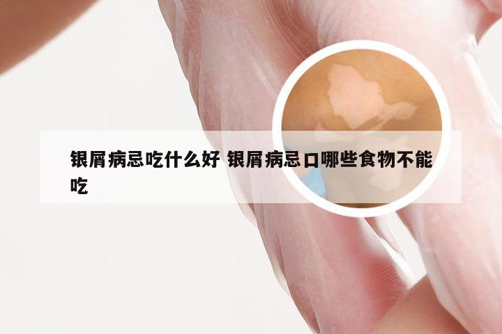 银屑病忌吃什么好 银屑病忌口哪些食物不能吃