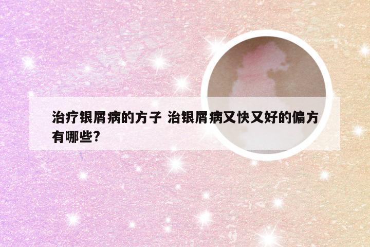 治疗银屑病的方子 治银屑病又快又好的偏方有哪些?