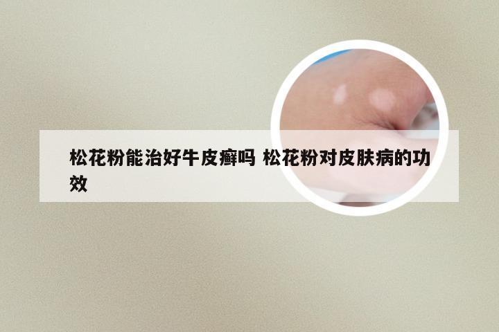 松花粉能治好牛皮癣吗 松花粉对皮肤病的功效