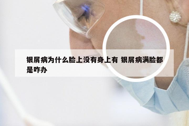 银屑病为什么脸上没有身上有 银屑病满脸都是咋办