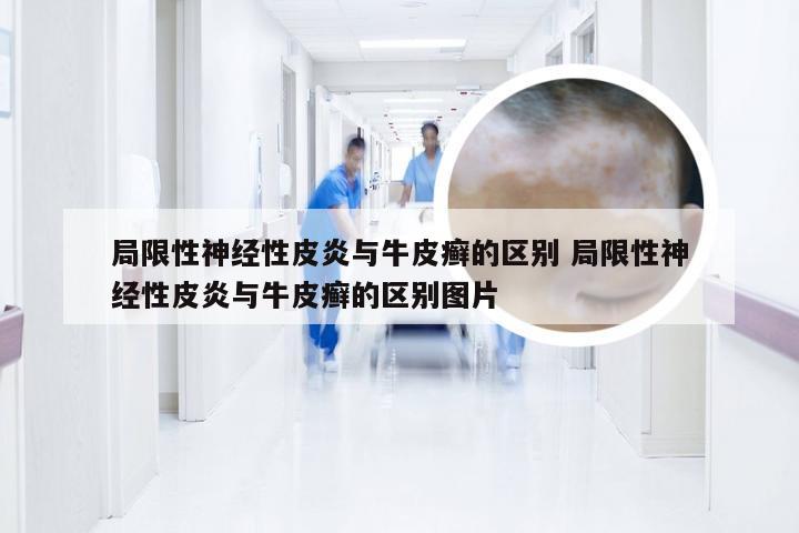 局限性神经性皮炎与牛皮癣的区别 局限性神经性皮炎与牛皮癣的区别图片