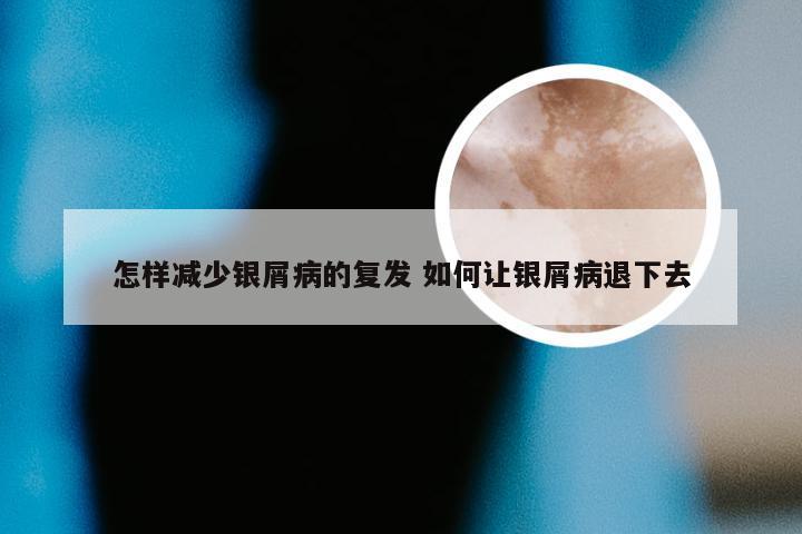 怎样减少银屑病的复发 如何让银屑病退下去