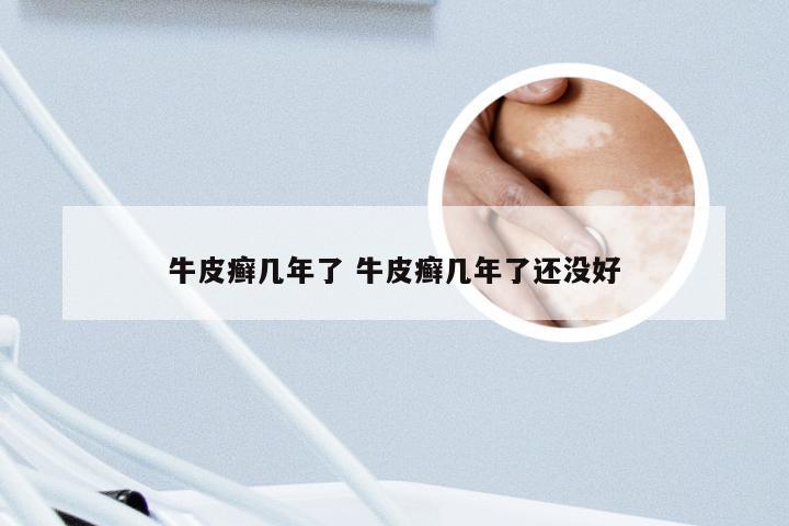 牛皮癣几年了 牛皮癣几年了还没好