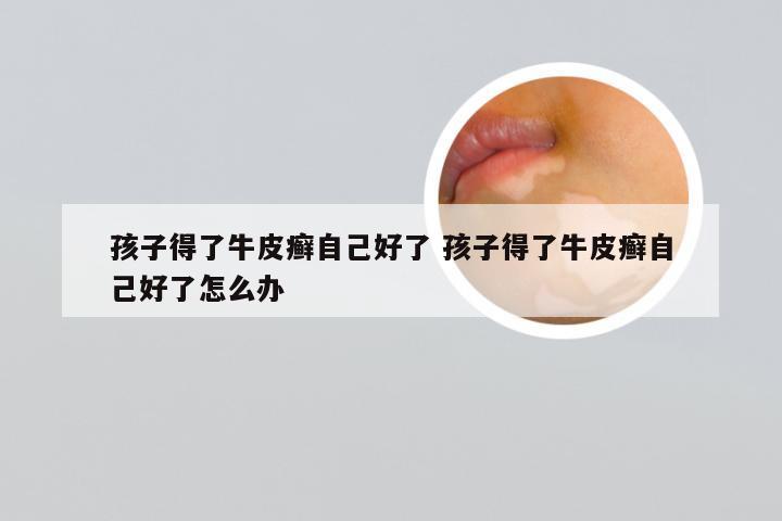 孩子得了牛皮癣自己好了 孩子得了牛皮癣自己好了怎么办