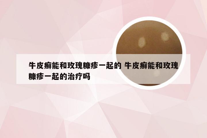 牛皮癣能和玫瑰糠疹一起的 牛皮癣能和玫瑰糠疹一起的治疗吗