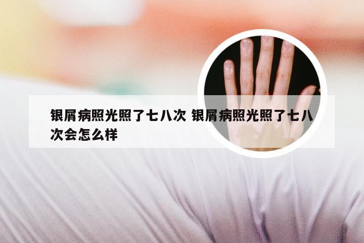 银屑病照光照了七八次 银屑病照光照了七八次会怎么样