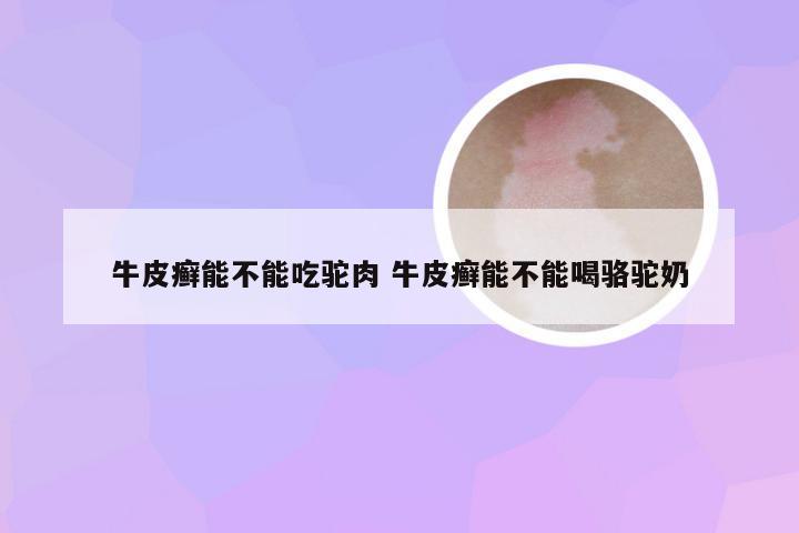 牛皮癣能不能吃驼肉 牛皮癣能不能喝骆驼奶