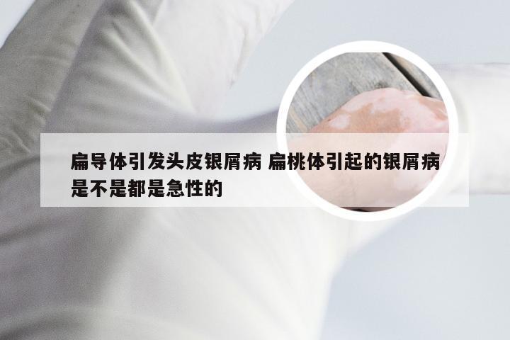 扁导体引发头皮银屑病 扁桃体引起的银屑病是不是都是急性的
