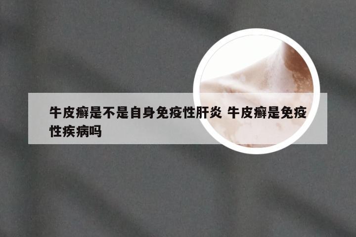 牛皮癣是不是自身免疫性肝炎 牛皮癣是免疫性疾病吗