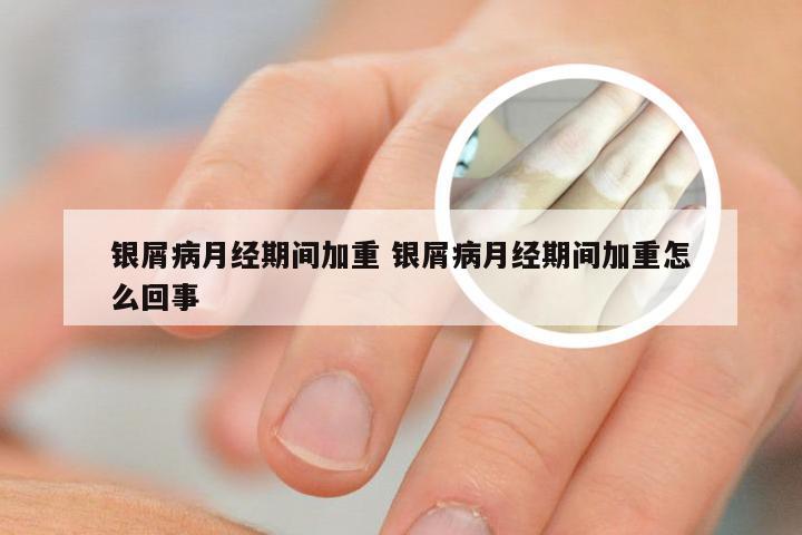 银屑病月经期间加重 银屑病月经期间加重怎么回事