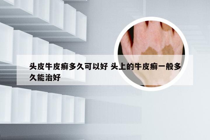 头皮牛皮癣多久可以好 头上的牛皮癣一般多久能治好