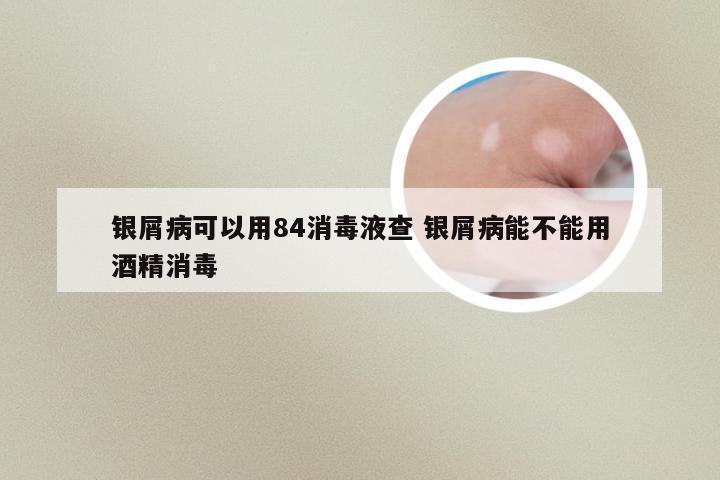 银屑病可以用84消毒液查 银屑病能不能用酒精消毒