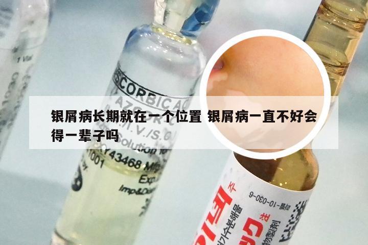 银屑病长期就在一个位置 银屑病一直不好会得一辈子吗