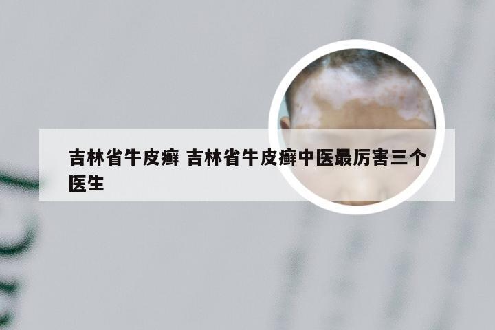 吉林省牛皮癣 吉林省牛皮癣中医最厉害三个医生