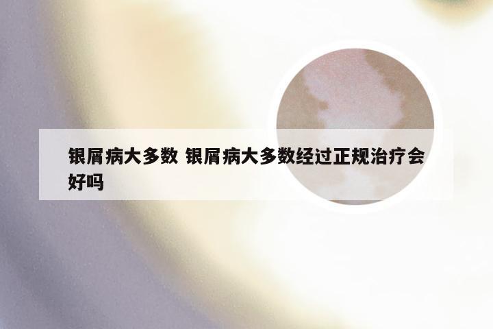 银屑病大多数 银屑病大多数经过正规治疗会好吗