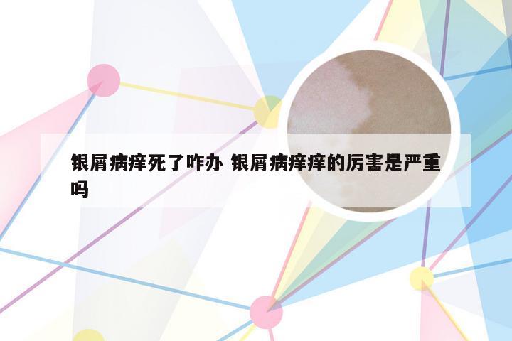 银屑病痒死了咋办 银屑病痒痒的厉害是严重吗