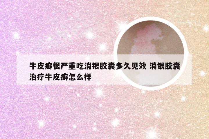 牛皮癣很严重吃消银胶囊多久见效 消银胶囊治疗牛皮癣怎么样