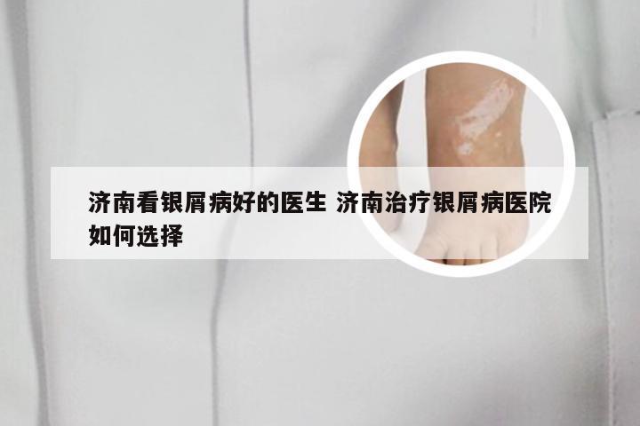 济南看银屑病好的医生 济南治疗银屑病医院如何选择