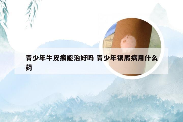 青少年牛皮癣能治好吗 青少年银屑病用什么药