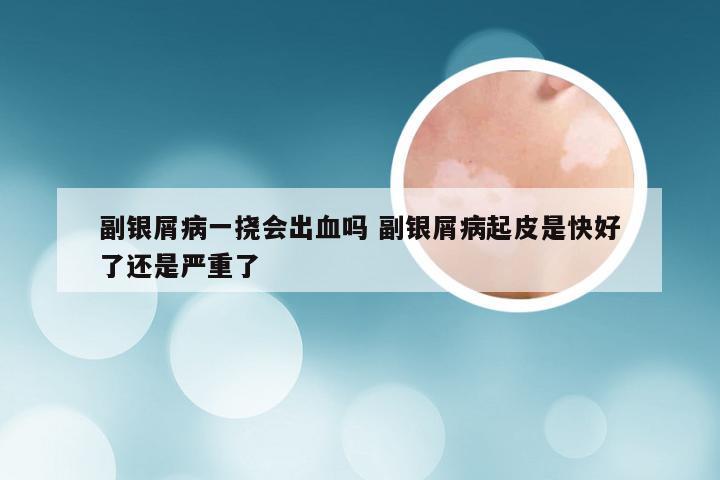 副银屑病一挠会出血吗 副银屑病起皮是快好了还是严重了