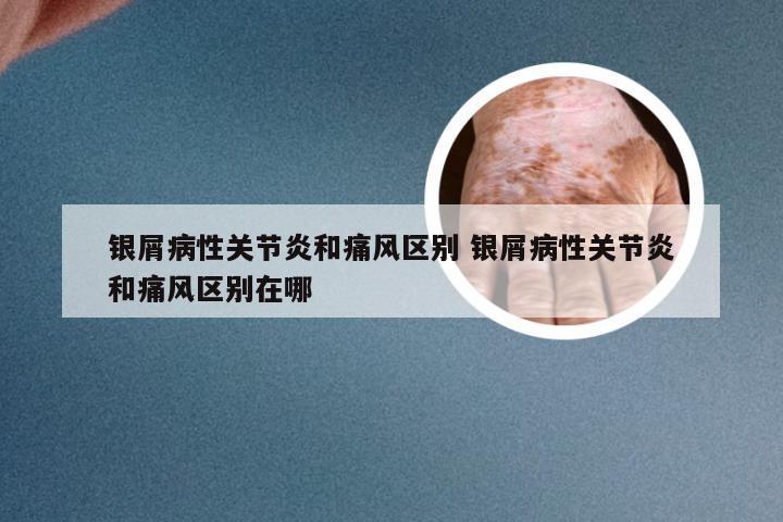 银屑病性关节炎和痛风区别 银屑病性关节炎和痛风区别在哪