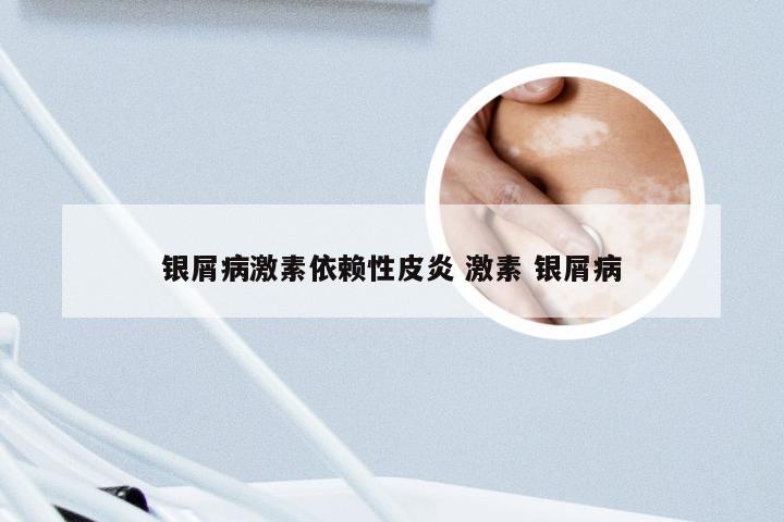 银屑病激素依赖性皮炎 激素 银屑病