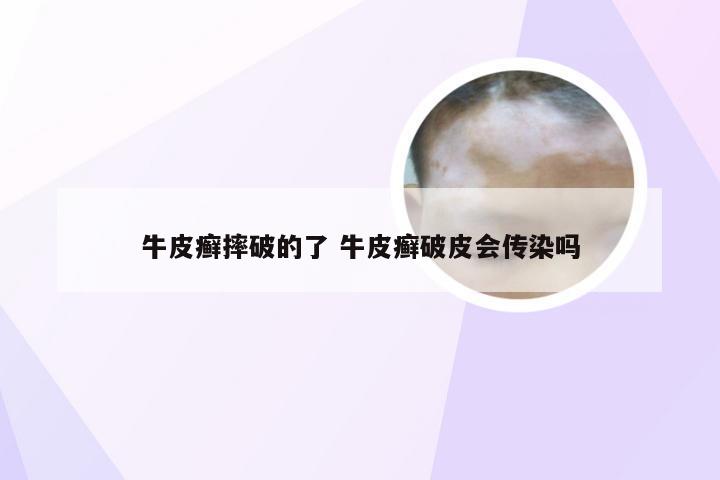牛皮癣摔破的了 牛皮癣破皮会传染吗