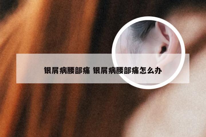 银屑病腰部痛 银屑病腰部痛怎么办