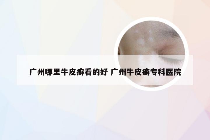 广州哪里牛皮癣看的好 广州牛皮癣专科医院