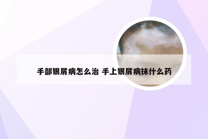 手部银屑病怎么治 手上银屑病抹什么药