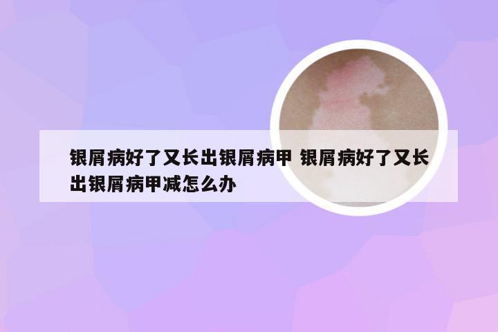 银屑病好了又长出银屑病甲 银屑病好了又长出银屑病甲减怎么办