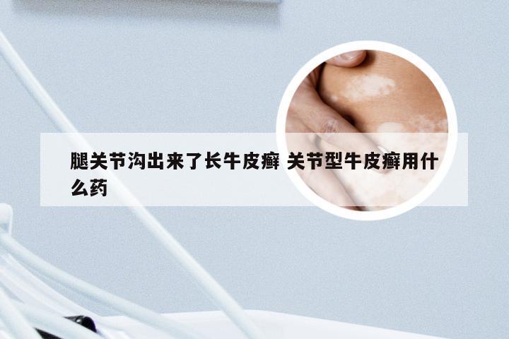 腿关节沟出来了长牛皮癣 关节型牛皮癣用什么药