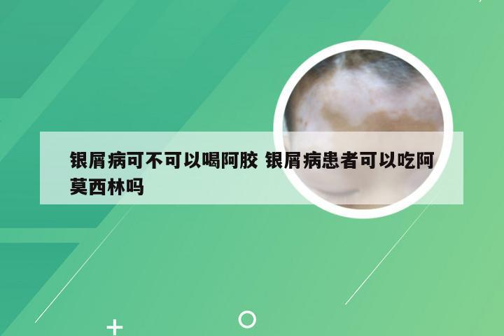 银屑病可不可以喝阿胶 银屑病患者可以吃阿莫西林吗