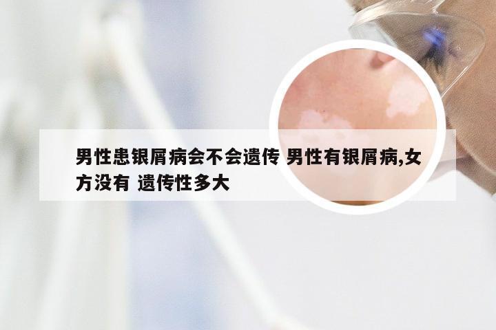 男性患银屑病会不会遗传 男性有银屑病,女方没有 遗传性多大