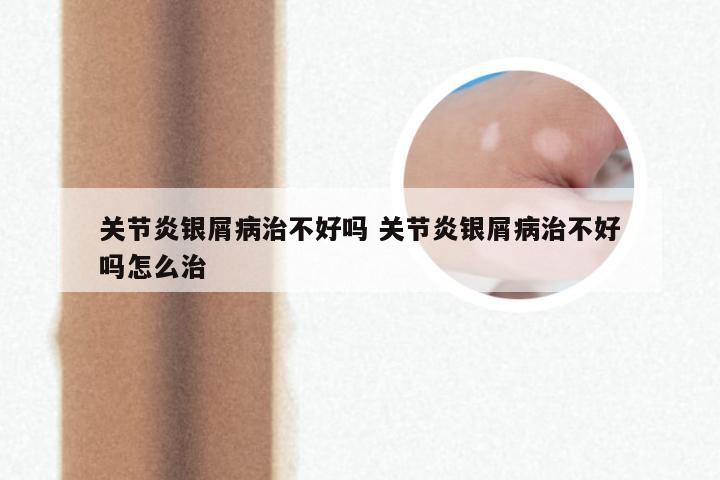 关节炎银屑病治不好吗 关节炎银屑病治不好吗怎么治