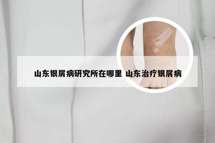 山东银屑病研究所在哪里 山东治疗银屑病
