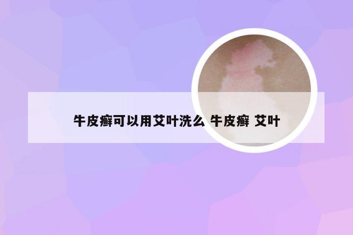 牛皮癣可以用艾叶洗么 牛皮癣 艾叶