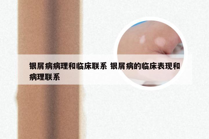 银屑病病理和临床联系 银屑病的临床表现和病理联系