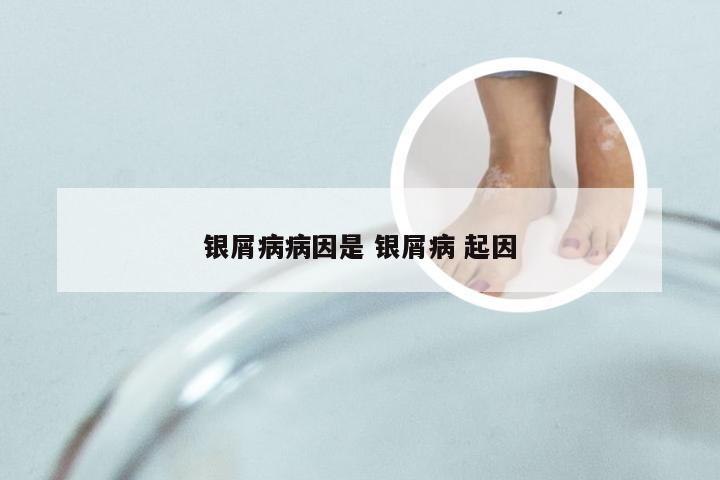 银屑病病因是 银屑病 起因